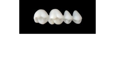Cod.S3UPPER RIGHT : 15x  posterior solid (not hollow) wax bridges, SMALL, (14-17) , with precarved occlusion to Cod.S3LOWER RIGHT,and compatible to Cod.E3UPPER RIGHT (hollow), (14-17)